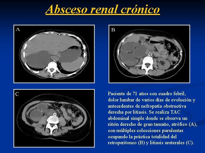 Absceso renal crónico Paciente de 71 años con cuadro febril, dolor lumbar de varios