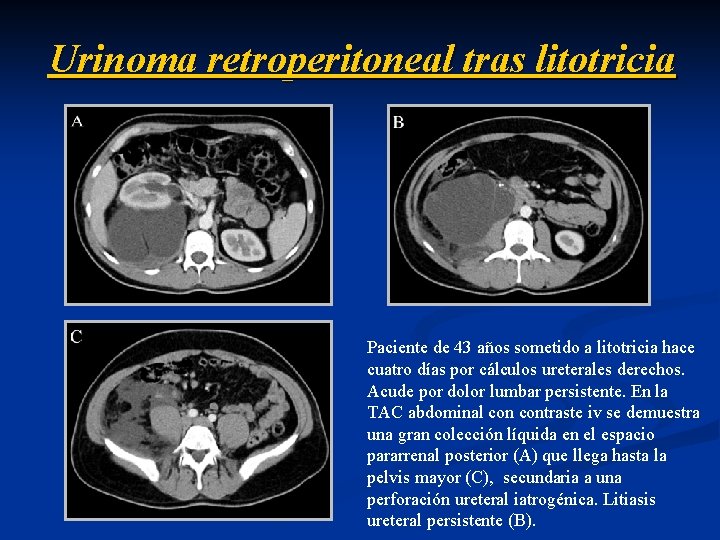 Urinoma retroperitoneal tras litotricia Paciente de 43 años sometido a litotricia hace cuatro días