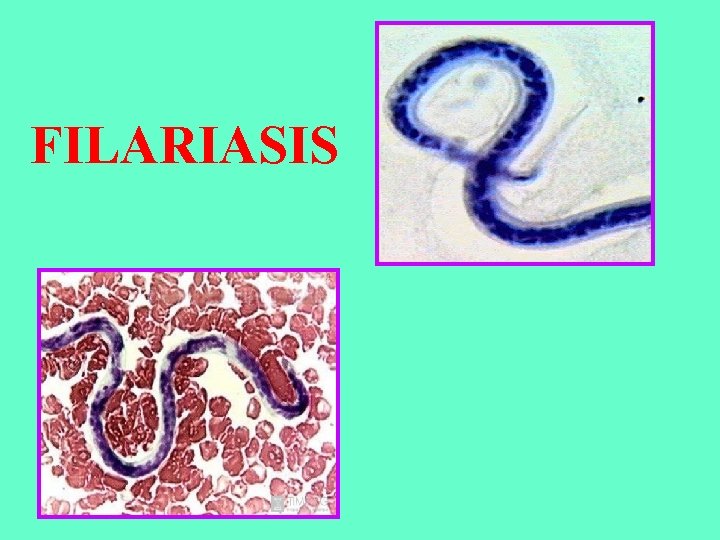 FILARIASIS 