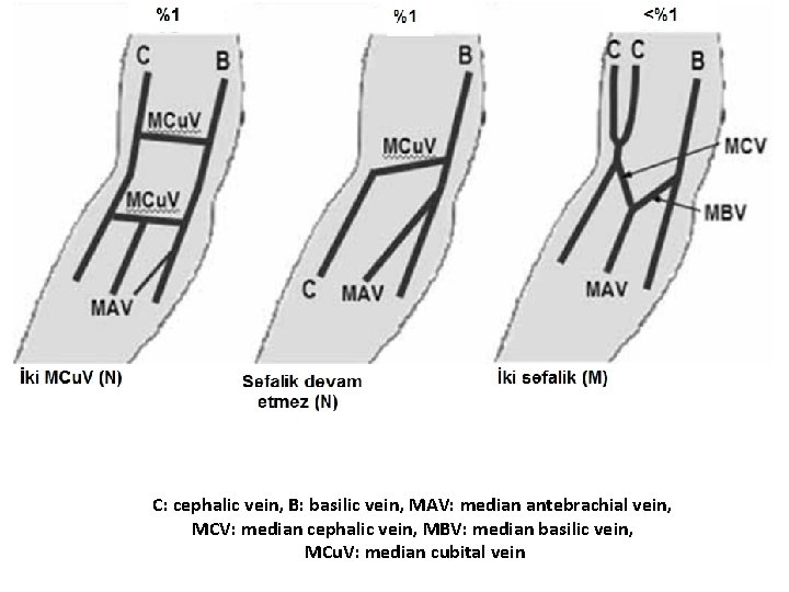 C: cephalic vein, B: basilic vein, MAV: median antebrachial vein, MCV: median cephalic vein, C: cephalic vein, B: basilic vein, MAV: median antebrachial vein, MCV: median cephalic vein,