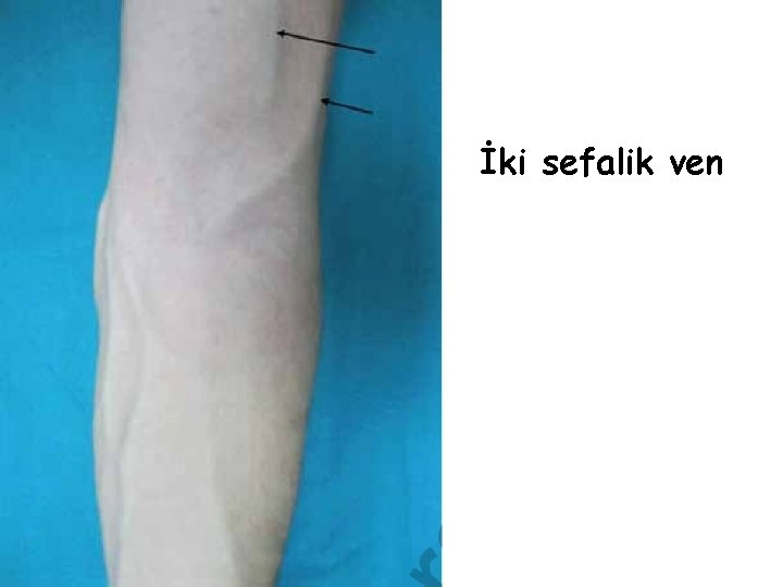 İki sefalik ven İki sefalik ven