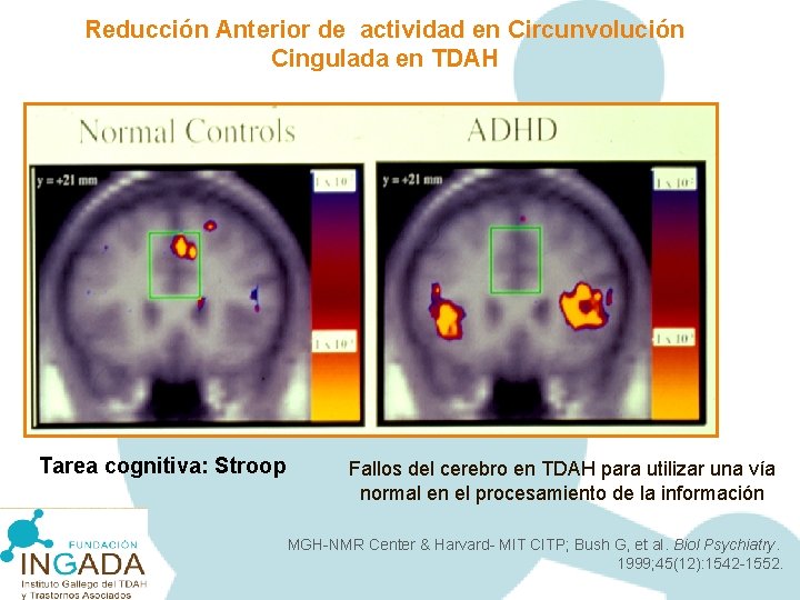 Reducción Anterior de actividad en Circunvolución Cingulada en TDAH Tarea cognitiva: Stroop Fallos del