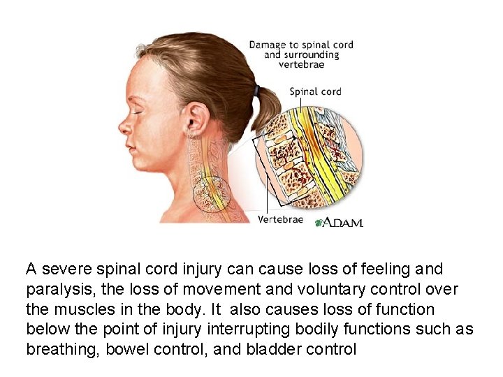 A severe spinal cord injury can cause loss of feeling and paralysis, the loss