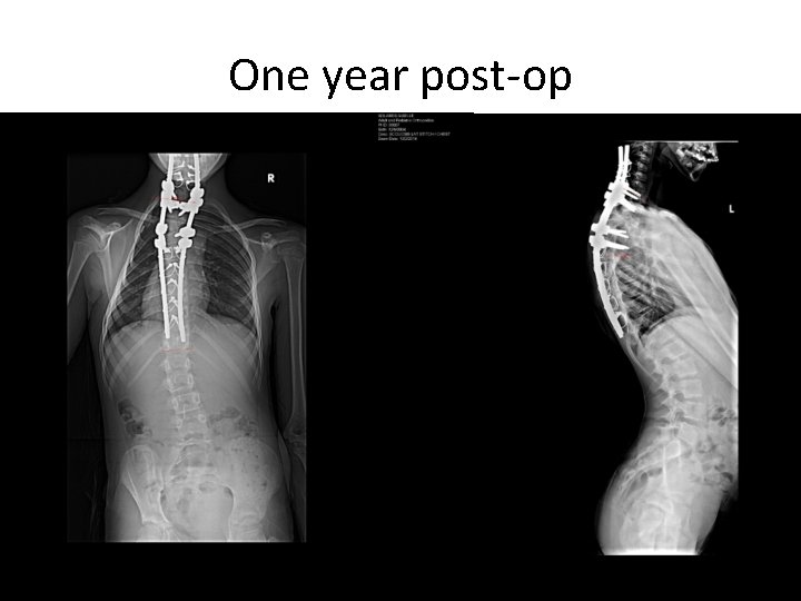 One year post-op 