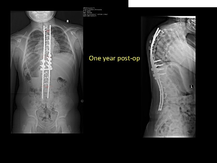 One year post-op 