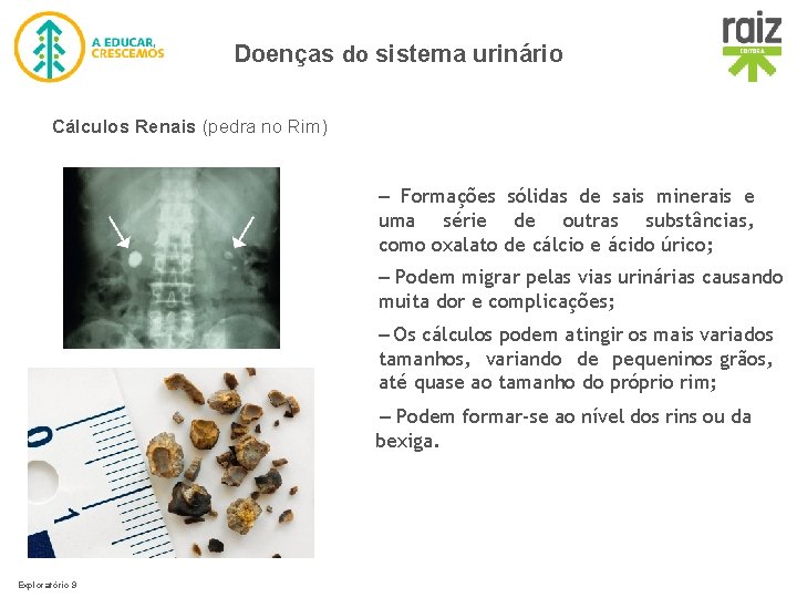 Doenças do sistema urinário Cálculos Renais (pedra no Rim) – Formações sólidas de sais