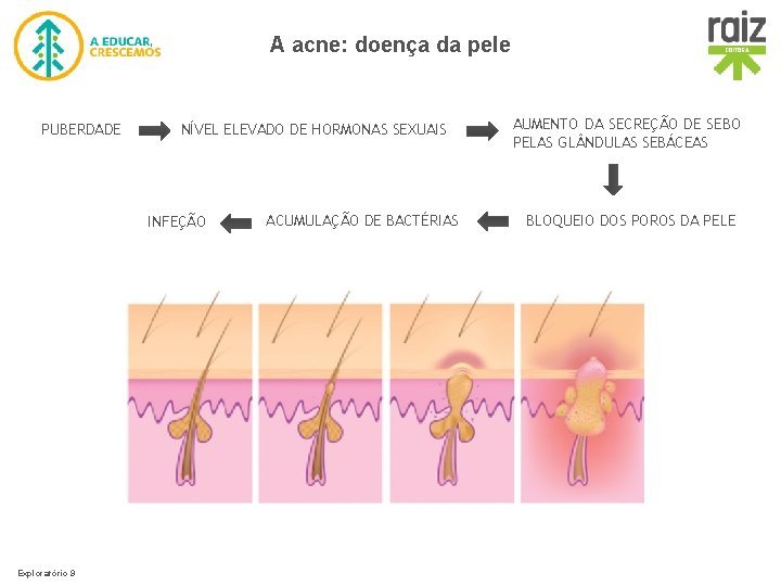 A acne: doença da pele PUBERDADE NÍVEL ELEVADO DE HORMONAS SEXUAIS INFEÇÃO Exploratório 9