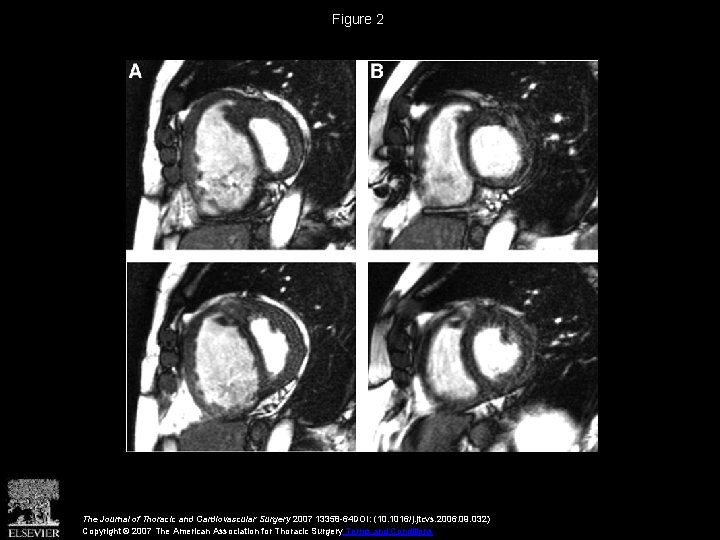 Figure 2 The Journal of Thoracic and Cardiovascular Surgery 2007 13358 -64 DOI: (10.