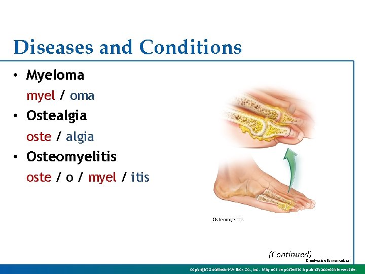 Diseases and Conditions • Myeloma myel / oma • Ostealgia oste / algia •