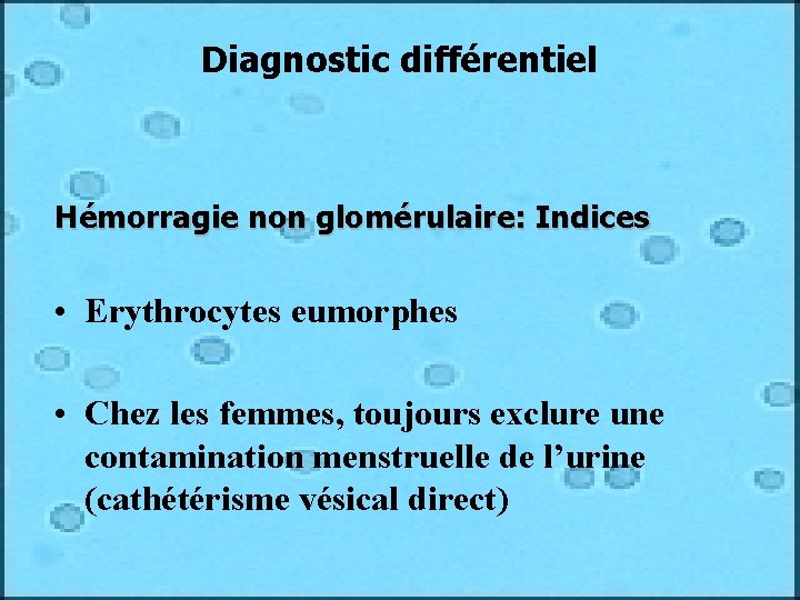 Diagnostic différentiel Hémorragie non glomérulaire: Indices • Erythrocytes eumorphes • Chez les femmes, toujours