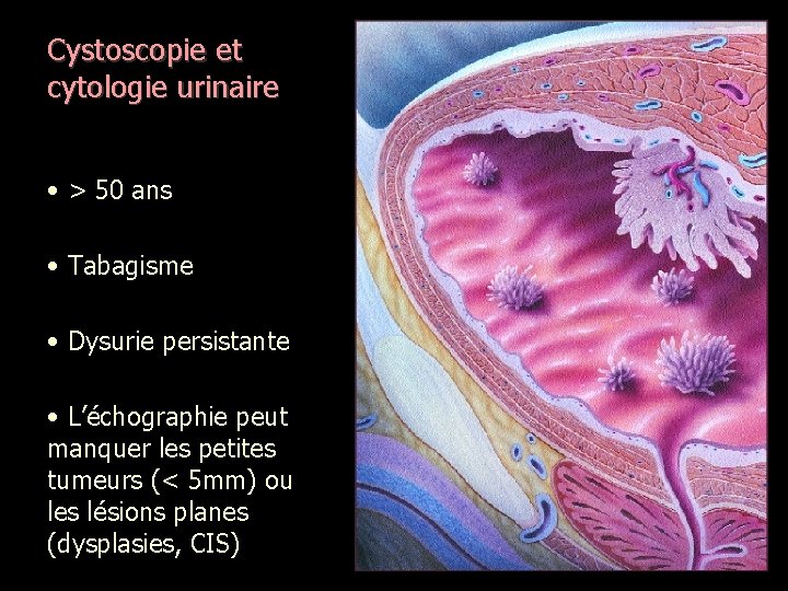 Cystoscopie et cytologie urinaire • > 50 ans • Tabagisme • Dysurie persistante •