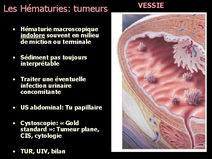 Les Hématuries: tumeurs • Hématurie macroscopique indolore souvent en milieu de miction ou terminale