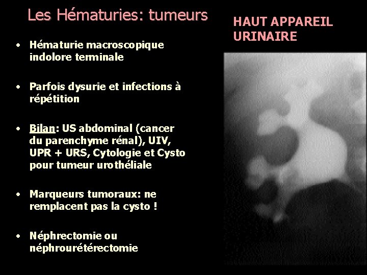 Les Hématuries: tumeurs • Hématurie macroscopique indolore terminale • Parfois dysurie et infections à