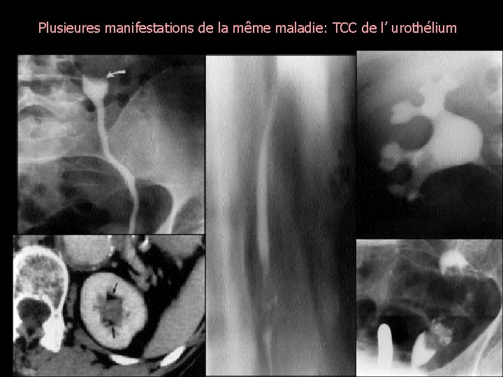 Plusieures manifestations de la même maladie: TCC de l’ urothélium 