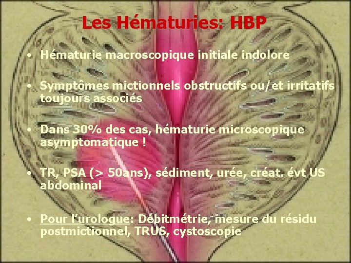 Les Hématuries: HBP • Hématurie macroscopique initiale indolore • Symptômes mictionnels obstructifs ou/et irritatifs