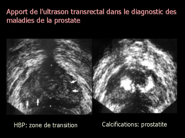 Apport de l’ultrason transrectal dans le diagnostic des maladies de la prostate HBP: zone
