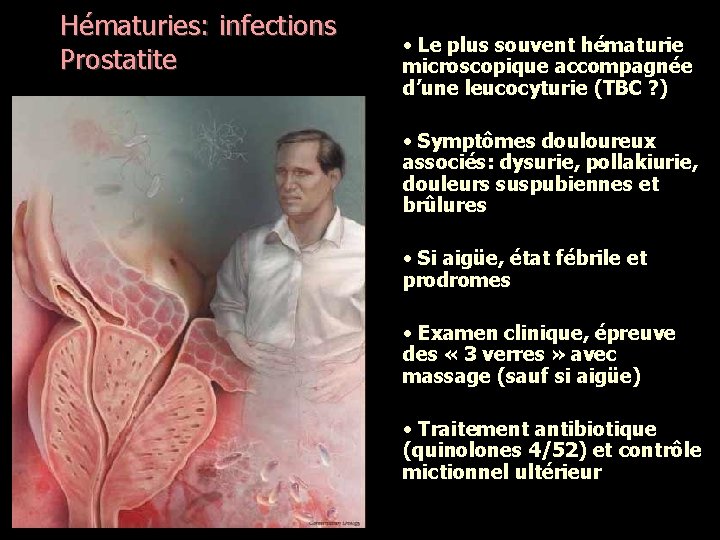 Hématuries: infections Prostatite • Le plus souvent hématurie microscopique accompagnée d’une leucocyturie (TBC ?