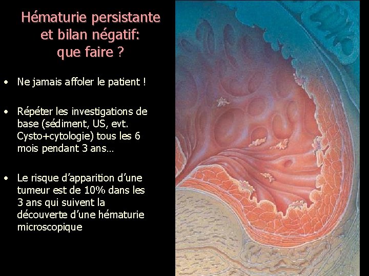 Hématurie persistante et bilan négatif: que faire ? • Ne jamais affoler le patient