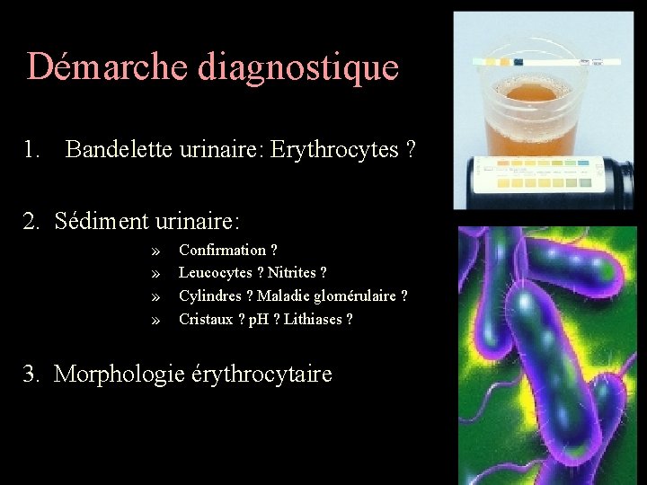 Démarche diagnostique 1. Bandelette urinaire: Erythrocytes ? 2. Sédiment urinaire: » » Confirmation ?