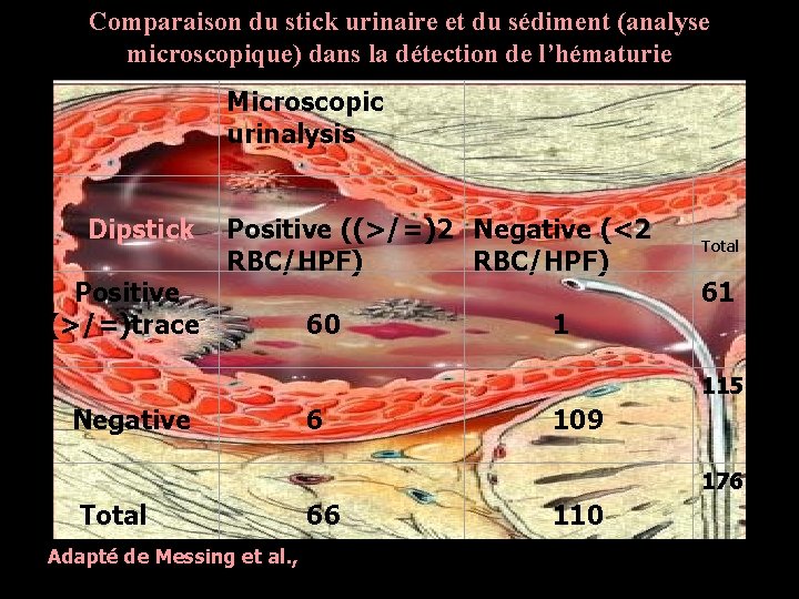 Comparaison du stick urinaire et du sédiment (analyse microscopique) dans la détection de l’hématurie