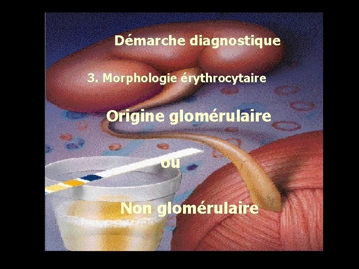 Démarche diagnostique 3. Morphologie érythrocytaire Origine glomérulaire ou Non glomérulaire 