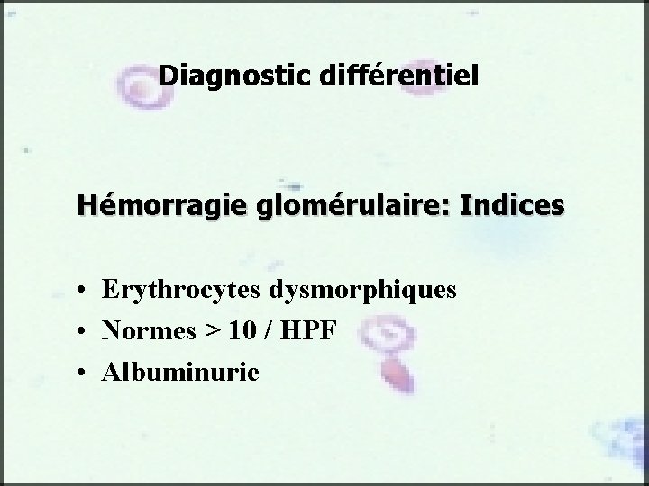 Diagnostic différentiel Hémorragie glomérulaire: Indices • Erythrocytes dysmorphiques • Normes > 10 / HPF