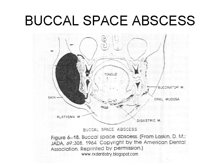 BUCCAL SPACE ABSCESS www. rxdentistry. blogspot. com 