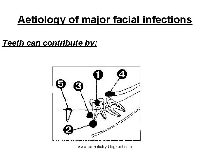 Aetiology of major facial infections Teeth can contribute by: www. rxdentistry. blogspot. com 