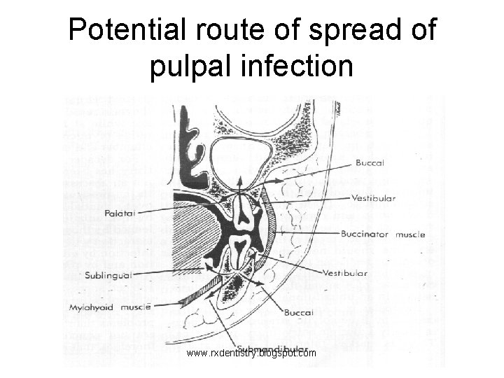 Potential route of spread of pulpal infection www. rxdentistry. blogspot. com 