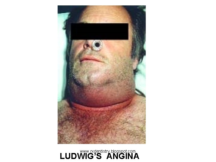 www. rxdentistry. blogspot. com LUDWIG’S ANGINA 