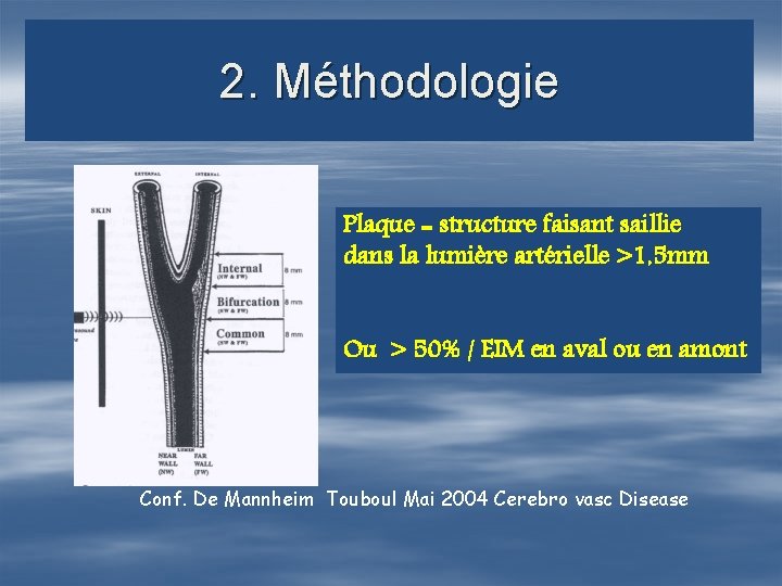 2. Méthodologie Plaque = structure faisant saillie dans la lumière artérielle >1, 5 mm