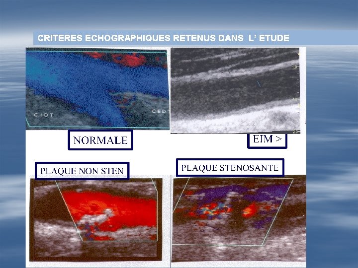 CRITERES ECHOGRAPHIQUES RETENUS DANS L’ ETUDE 