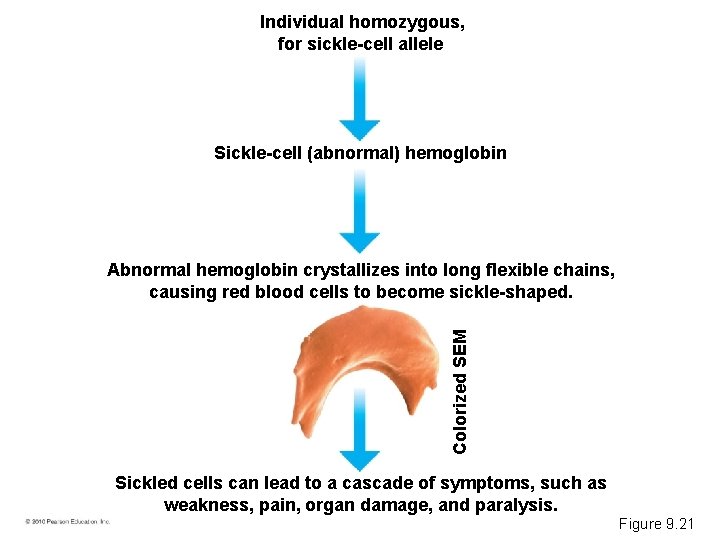 Individual homozygous, for sickle-cell allele Sickle-cell (abnormal) hemoglobin Colorized SEM Abnormal hemoglobin crystallizes into