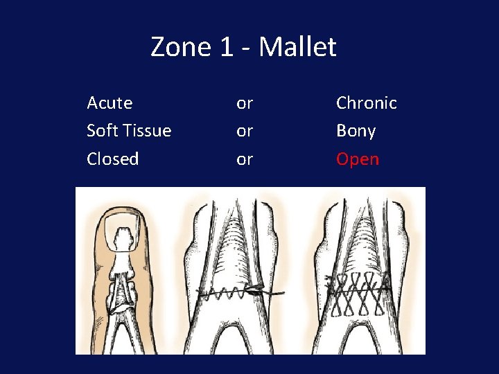 Zone 1 - Mallet Acute Soft Tissue Closed or or or Chronic Bony Open