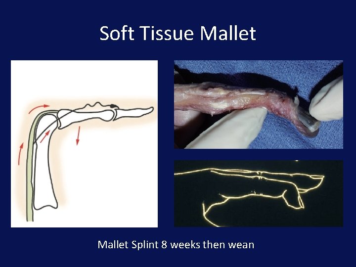 Soft Tissue Mallet Splint 8 weeks then wean 