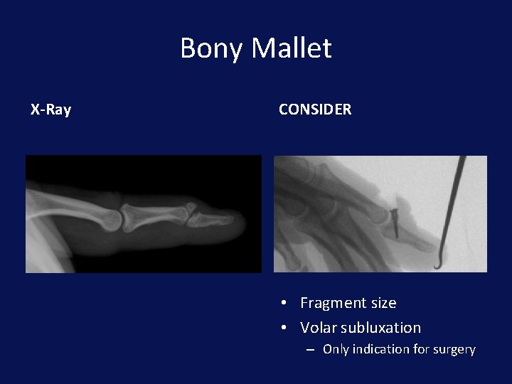 Bony Mallet X-Ray CONSIDER • Fragment size • Volar subluxation – Only indication for