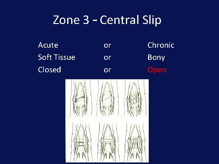 Zone 3 – Central Slip Acute Soft Tissue Closed or or or Chronic Bony