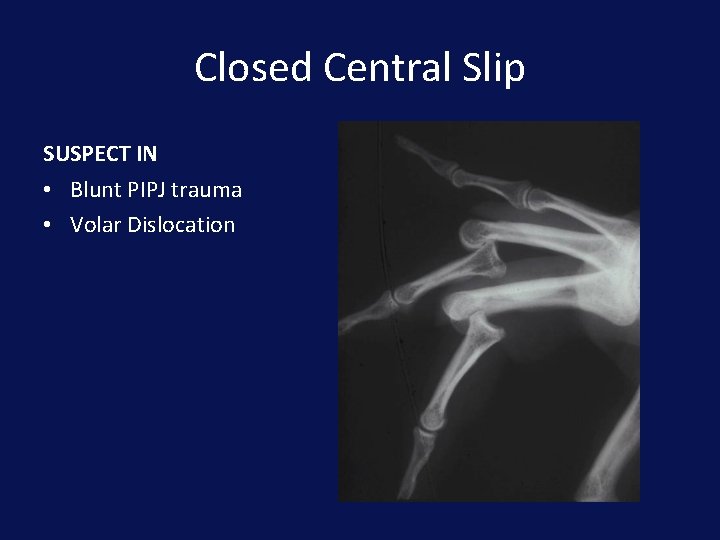 Closed Central Slip SUSPECT IN • Blunt PIPJ trauma • Volar Dislocation 