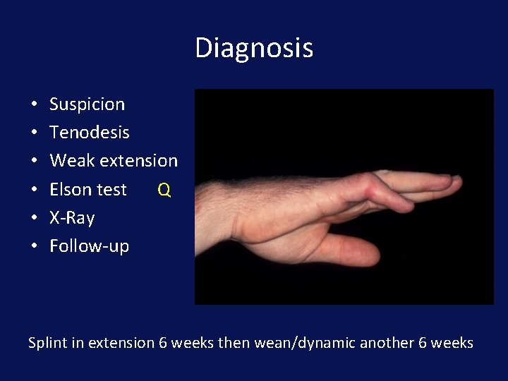 Diagnosis • • • Suspicion Tenodesis Weak extension Elson test Q X-Ray Follow-up Splint