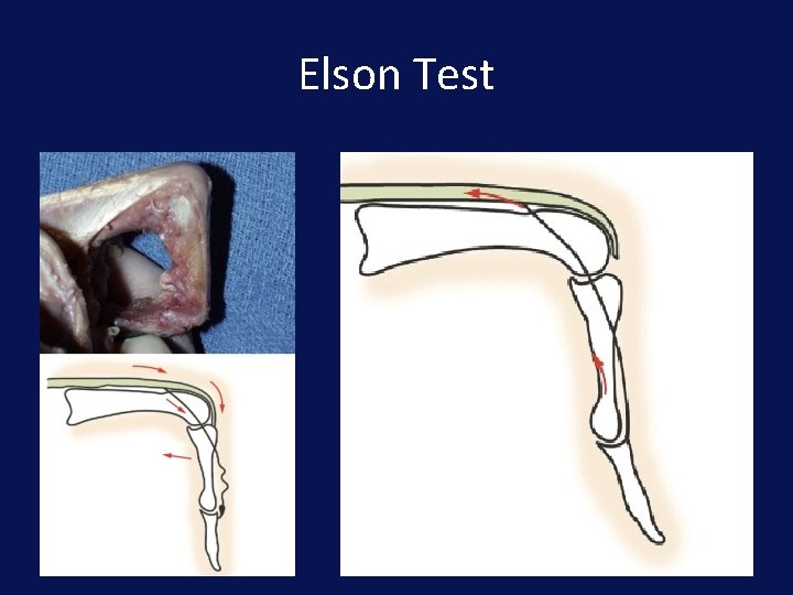 Elson Test 