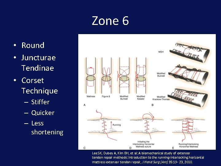 Zone 6 • Round • Juncturae Tendinae • Corset Technique – Stiffer – Quicker