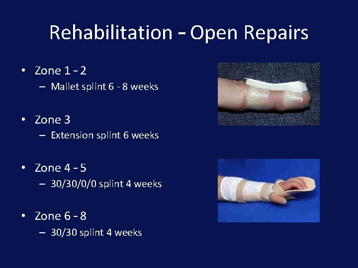 Rehabilitation – Open Repairs • Zone 1 – 2 – Mallet splint 6 -