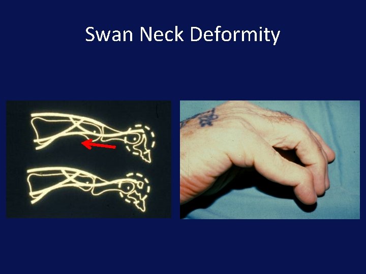 Swan Neck Deformity 