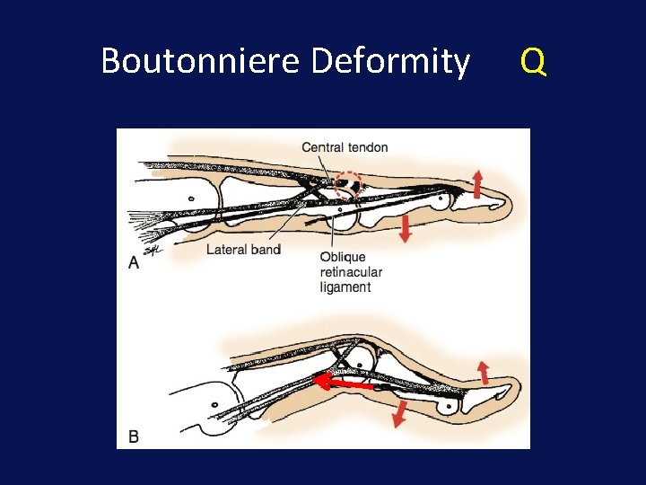 Boutonniere Deformity Q 