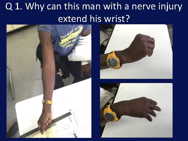 Q 1. Why can this man with a nerve injury extend his wrist? 