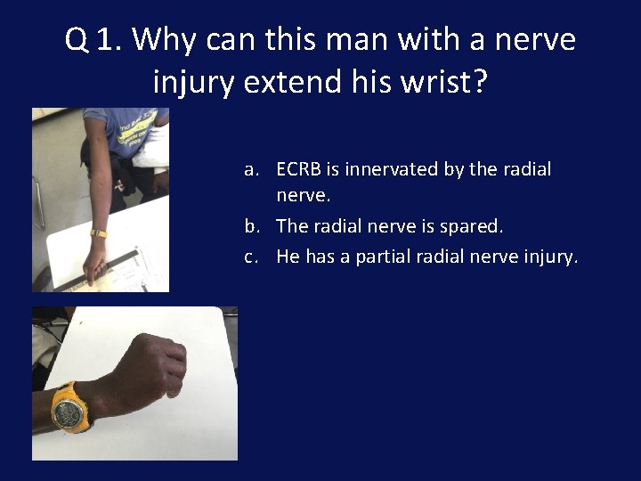 Q 1. Why can this man with a nerve injury extend his wrist? a.