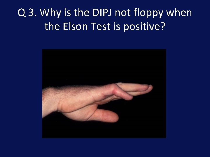 Q 3. Why is the DIPJ not floppy when the Elson Test is positive?