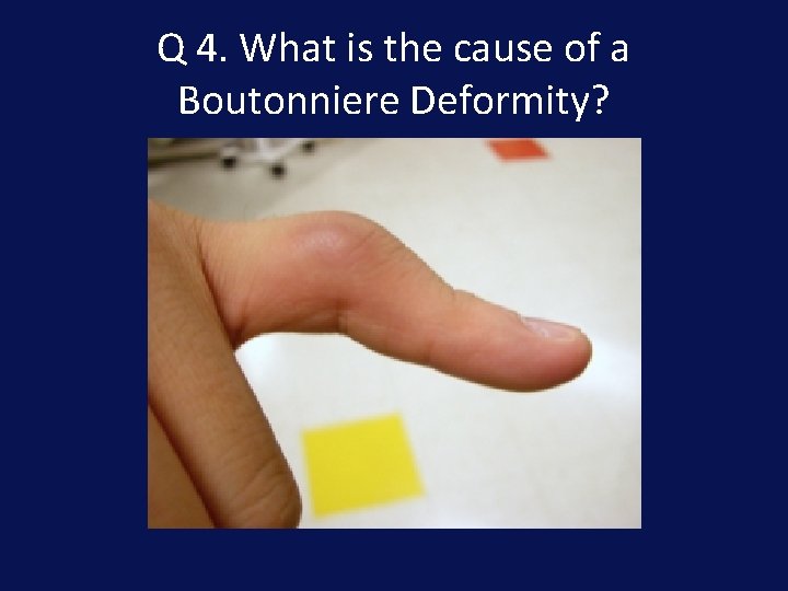 Q 4. What is the cause of a Boutonniere Deformity? 