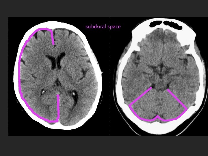 subdural space 