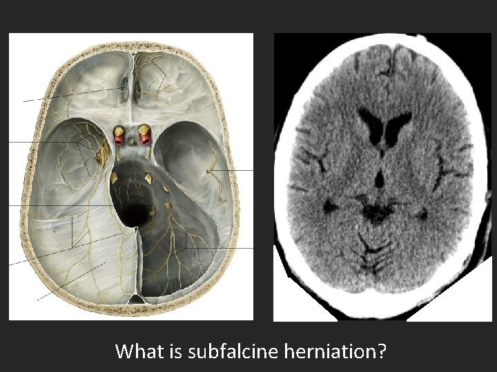 What is subfalcine herniation? 